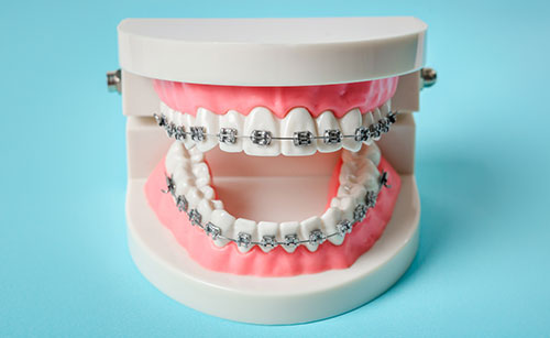Metal Braces